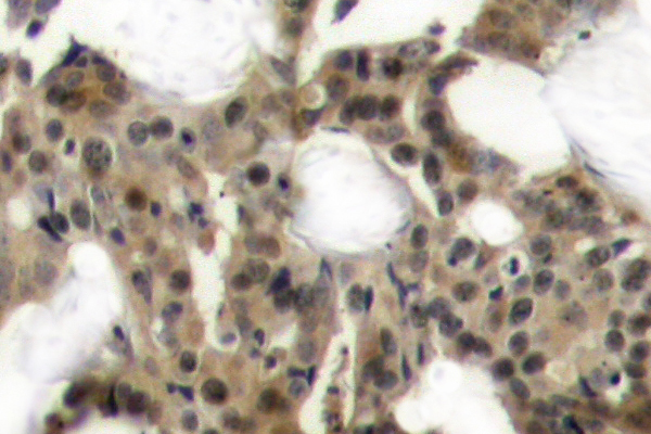 EIF4EBP1 / 4EBP1 Antibody - IHC of 4E-BP1 (G39) pAb in paraffin-embedded human breast carcinoma tissue.