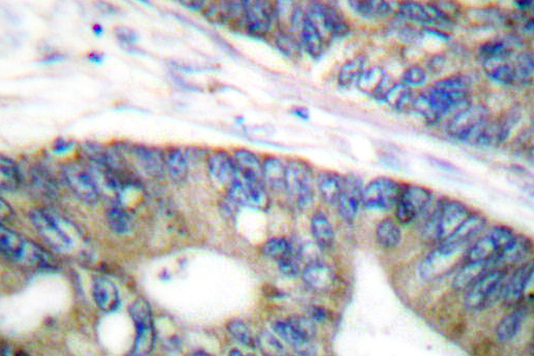 EIF4EBP1 / 4EBP1 Antibody - IHC of 4E-BP1 (L58) pAb in paraffin-embedded human colon carcinoma tissue.
