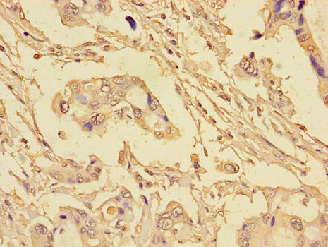 EIF4EBP1 / 4EBP1 Antibody - Immunohistochemistry of paraffin-embedded human pancreatic cancer tissue using EIF4EBP1 Antibody at dilution of 1:100