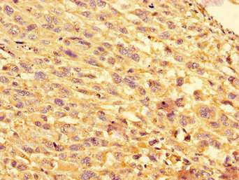 EIF4EBP1 / 4EBP1 Antibody - Immunohistochemistry of paraffin-embedded human melanoma using EIF4EBP1 Antibody at dilution of 1:100