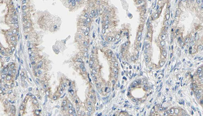 EIF4EBP1 / 4EBP1 Antibody - 1:100 staining human prostate tissue by IHC-P. The sample was formaldehyde fixed and a heat mediated antigen retrieval step in citrate buffer was performed. The sample was then blocked and incubated with the antibody for 1.5 hours at 22°C. An HRP conjugated goat anti-rabbit antibody was used as the secondary.