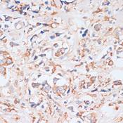 EIF4EBP1 / 4EBP1 Antibody - Immunohistochemistry of paraffin-embedded Human breast cancer using EIF4EBP1 Polyclonal Antibody at dilution of 1:100 (40x lens).