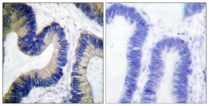 EIF4EBP1 / 4EBP1 Antibody - Immunohistochemistry analysis of paraffin-embedded human colon carcinoma, using 4E-BP1 (Phospho-Ser64) Antibody. The picture on the right is blocked with the phospho peptide.