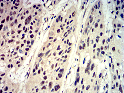 EIF4EBP1 / 4EBP1 Antibody - Immunohistochemical analysis of paraffin-embedded esophageal cancer tissues using Phospho-4E-BP1 (Ser65) mouse mAb with DAB staining.