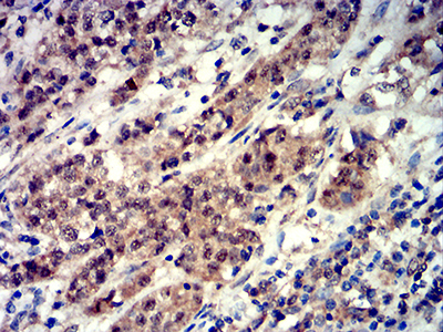 EIF4EBP1 / 4EBP1 Antibody - Immunohistochemical analysis of paraffin-embedded bladder cancer tissues using Phospho-4E-BP1 (Ser65) mouse mAb with DAB staining.
