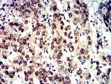 EIF4EBP1 / 4EBP1 Antibody - Immunohistochemical analysis of paraffin-embedded stomach cancer tissues using Phospho-4E-BP1 (Ser65) mouse mAb with DAB staining.