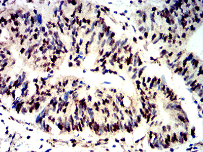 EIF4EBP1 / 4EBP1 Antibody - Immunohistochemical analysis of paraffin-embedded rectum cancer tissues using Phospho-4E-BP1 (Ser65) mouse mAb with DAB staining.