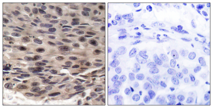 EIF4EBP1 / 4EBP1 Antibody - Immunohistochemistry analysis of paraffin-embedded human breast carcinoma, using 4E-BP1 (Phospho-Thr36) Antibody. The picture on the right is blocked with the phospho peptide.