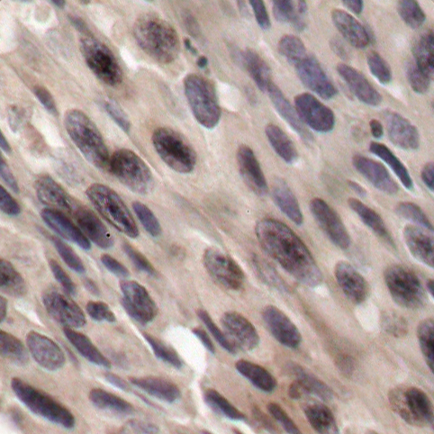 EIF4EBP1 / 4EBP1 Antibody - Immunohistochemical analysis of paraffin-embedded human breast carcinoma.