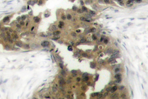 EIF4EBP1 / 4EBP1 Antibody - IHC of p-4E-BP1 (T37) pAb in paraffin-embedded human breast carcinoma tissue.