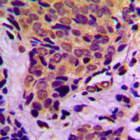 EIF4EBP1 / 4EBP1 Antibody - Immunohistochemical analysis of 4EBP1 (pT37) staining in human breast cancer formalin fixed paraffin embedded tissue section. The section was pre-treated using heat mediated antigen retrieval with sodium citrate buffer (pH 6.0). The section was then incubated with the antibody at room temperature and detected using an HRP conjugated compact polymer system. DAB was used as the chromogen. The section was then counterstained with hematoxylin and mounted with DPX.