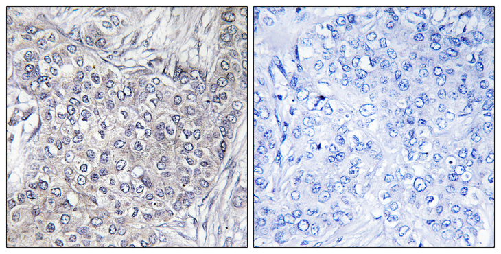 EIF4EBP1 / 4EBP1 Antibody - Immunohistochemistry analysis of paraffin-embedded human breast carcinoma, using 4E-BP1 (Phospho-Thr45) Antibody. The picture on the right is blocked with the phospho peptide.