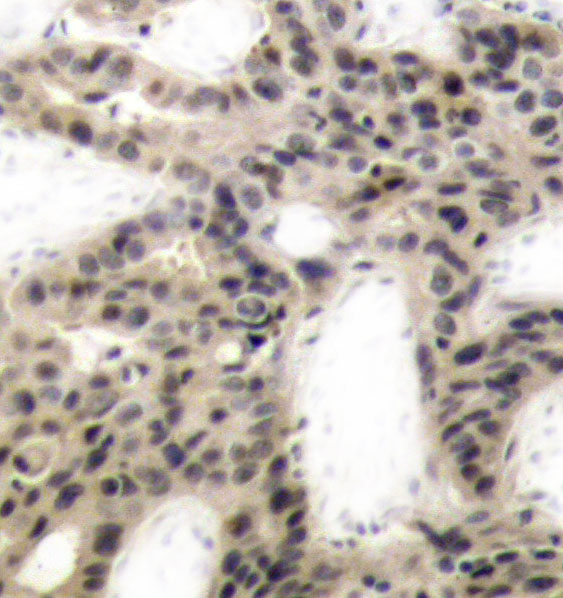 EIF4EBP1 / 4EBP1 Antibody - Immunohistochemical analysis of paraffin-embedded human breast carcinoma tissue.