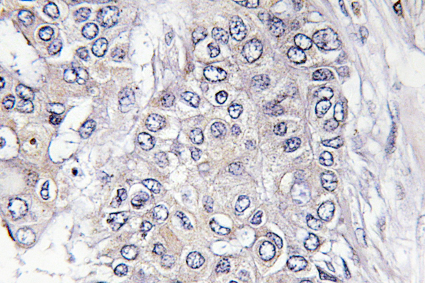 EIF4EBP1 / 4EBP1 Antibody - IHC of p-4E-BP1 (T46) pAb in paraffin-embedded human breast carcinoma tissue.