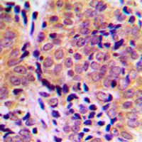 EIF4EBP1 / 4EBP1 Antibody - Immunohistochemical analysis of 4EBP1 (pT46) staining in human breast cancer formalin fixed paraffin embedded tissue section. The section was pre-treated using heat mediated antigen retrieval with sodium citrate buffer (pH 6.0). The section was then incubated with the antibody at room temperature and detected using an HRP conjugated compact polymer system. DAB was used as the chromogen. The section was then counterstained with hematoxylin and mounted with DPX.