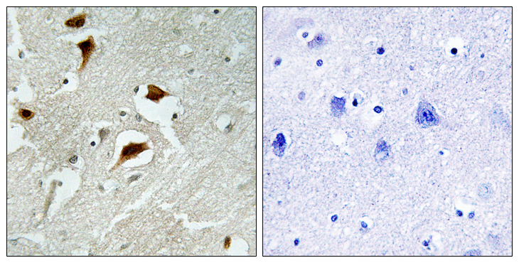 EIF4EBP1 / 4EBP1 Antibody - Immunohistochemistry analysis of paraffin-embedded human brain carcinoma, using 4E-BP1 (Phospho-Thr69) Antibody. The picture on the right is blocked with the phospho peptide.
