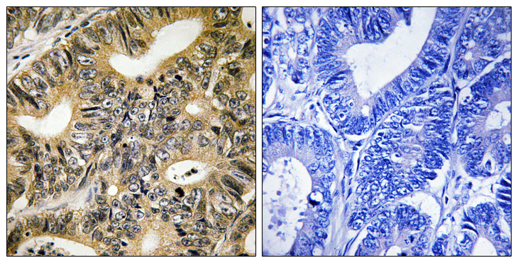 EIF4EBP1 / 4EBP1 Antibody - Immunohistochemistry analysis of paraffin-embedded human colon carcinoma, using 4E-BP1 (Phospho-Thr70) Antibody. The picture on the right is blocked with the phospho peptide.
