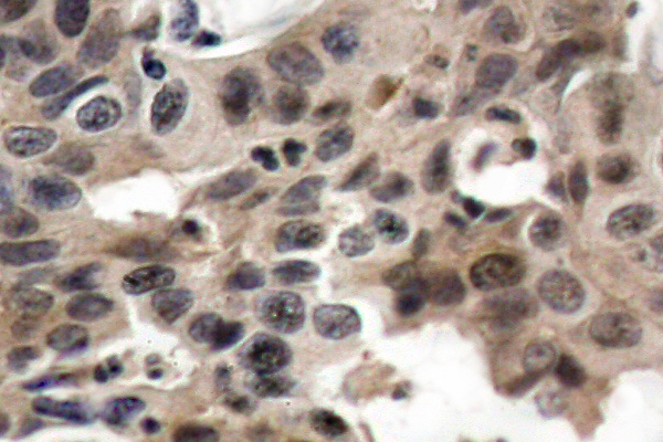 EIF4EBP1 / 4EBP1 Antibody - IHC of 4E-BP1 (P30) pAb in paraffin-embedded human breast carcinoma tissue.