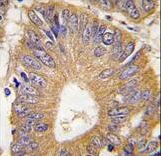 EIF4EBP1 / 4EBP1 Antibody - Formalin-fixed and paraffin-embedded human colon carcinoma tissue reacted with EIF4EBP1 Antibody (T69) , which was peroxidase-conjugated to the secondary antibody, followed by DAB staining. This data demonstrates the use of this antibody for immunohistochemistry; clinical relevance has not been evaluated.