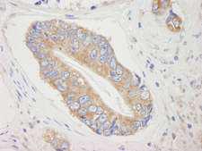 EIF4ENIF1 / 4E-T Antibody - Detection of Human 4E-T/elF4E-T by Immunohistochemistry. Sample: FFPE section of human prostate adenocarcinoma. Antibody: Affinity purified rabbit anti-4E-T/elF4E-T used at a dilution of 1:250.