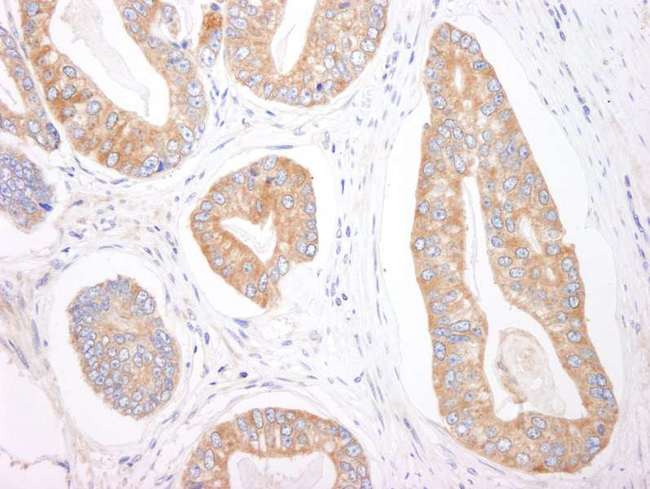 EIF4ENIF1 / 4E-T Antibody - Detection of Human 4E-T by Immunohistochemistry. Sample: FFPE section of human prostate carcinoma. Antibody: Affinity purified rabbit anti-4E-T used at a dilution of 1:1000 (1 ug/ml).