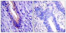 EIF4G1 / EIF4G Antibody - Immunohistochemistry analysis of paraffin-embedded human colon carcinoma tissue, using eIF4G Antibody. The picture on the right is blocked with the synthesized peptide.