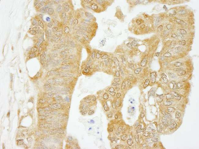 EIF4G1 / EIF4G Antibody - Detection of Human eIF4G1/eIF4GI by Immunohistochemistry. Sample: FFPE section of human ovarian carcinoma. Antibody: Affinity purified rabbit anti-eIF4G1/eIF4GI used at a dilution of 1:500.