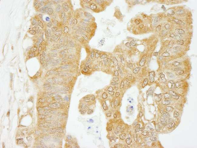 EIF4G1 / EIF4G Antibody - Detection of Human eIF4G1 by Immunohistochemistry. Sample: FFPE section of human ovarian carcinoma. Antibody: Affinity purified rabbit anti-eIF4G1 used at a dilution of1:200 (1Detection: DAB.