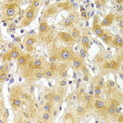 EIF4G1 / EIF4G Antibody - Immunohistochemistry of paraffin-embedded Human liver injury tissue.