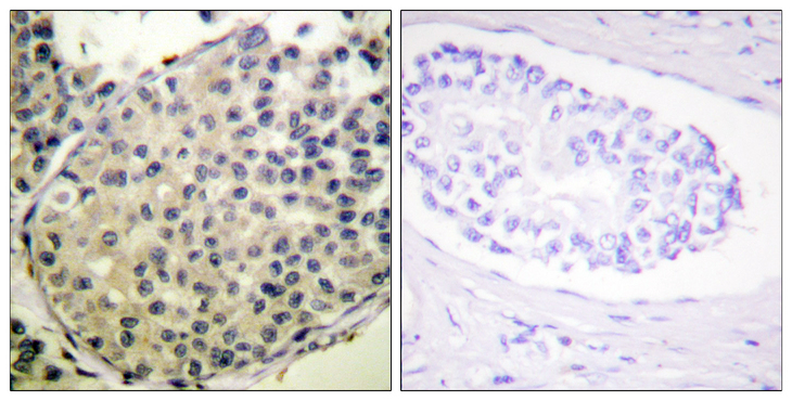 EIF4G1 / EIF4G Antibody - Immunohistochemistry analysis of paraffin-embedded human breast carcinoma, using eIF4G (Phospho-Ser1108) Antibody. The picture on the right is blocked with the phospho peptide.