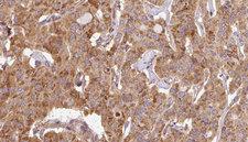 EIF4G1 / EIF4G Antibody - 1:100 staining human thyroid carcinoma tissue by IHC-P. The sample was formaldehyde fixed and a heat mediated antigen retrieval step in citrate buffer was performed. The sample was then blocked and incubated with the antibody for 1.5 hours at 22°C. An HRP conjugated goat anti-rabbit antibody was used as the secondary.