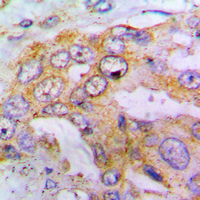 EIF4G1 / EIF4G Antibody - Immunohistochemical analysis of EIF4G1 (pS1148) staining in human lung cancer formalin fixed paraffin embedded tissue section. The section was pre-treated using heat mediated antigen retrieval with sodium citrate buffer (pH 6.0). The section was then incubated with the antibody at room temperature and detected using an HRP conjugated compact polymer system. DAB was used as the chromogen. The section was then counterstained with hematoxylin and mounted with DPX.