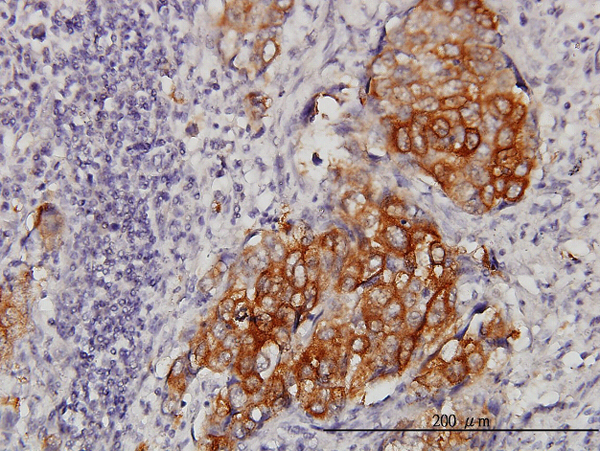 EIF4G3 Antibody - Immunoperoxidase of monoclonal antibody to EIF4G3 on formalin-fixed paraffin-embedded human lung, adenosquamous cell carcinoma. [antibody concentration 3 ug/ml].