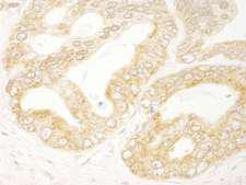 EIF4H Antibody - Detection of Human eIF4H by Immunohistochemistry. Sample: FFPE section of human prostate carcinoma. Antibody: Affinity purified rabbit anti-eIF4H used at a dilution of 1:250.