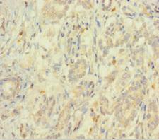 EIF5 Antibody - Immunohistochemistry of paraffin-embedded human pancreatic cancer using EIF5 Antibody at dilution of 1:100