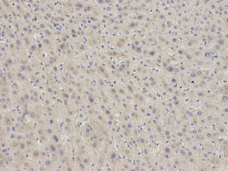 EIF5A Antibody - Immunohistochemistry of paraffin-embedded human kidney cancer using EIF5A antibody at dilution of 1:200 (200x lens).