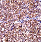 EIF5A2 Antibody - EIF5A2 Antibody immunohistochemistry of formalin-fixed and paraffin-embedded human ovarian carcinoma followed by peroxidase-conjugated secondary antibody and DAB staining.