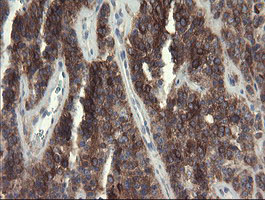EIF5A2 Antibody - IHC of paraffin-embedded Carcinoma of Human pancreas tissue using anti-EIF5A2 mouse monoclonal antibody.
