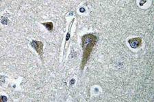 EIF5B / IF2 Antibody - IHC of eIF5B (H1086) pAb in paraffin-embedded human breast carcinoma tissue.