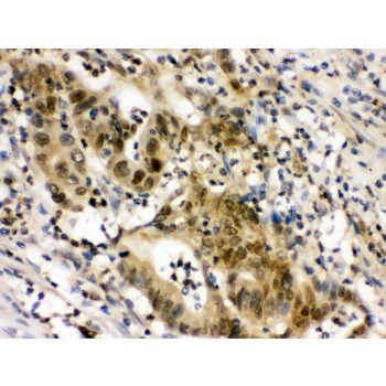 EIF6 Antibody - EIF6 antibody IHC-paraffin. IHC(P): Human Intestinal Cancer Tissue.