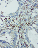EIF6 Antibody - EIF6 antibody. IHC(P): Human Intestinal Cancer Tissue.
