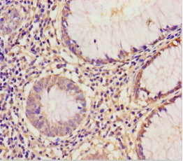 EIF6 Antibody - Immunohistochemistry of paraffin-embedded human colon cancer using EIF6 Antibody at dilution of 1:100