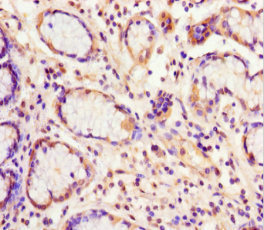 EIF6 Antibody - Immunohistochemistry of paraffin-embedded human gastric cancer using EIF6 Antibody at dilution of 1:100