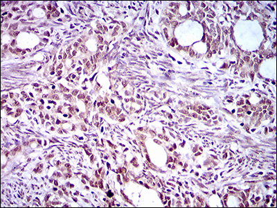 EKLF / KLF1 Antibody - IHC of paraffin-embedded cervical cancer tissues using KLF1 mouse monoclonal antibody with DAB staining.