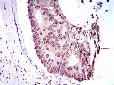 EKLF / KLF1 Antibody - IHC of paraffin-embedded rectum cancer tissues using KLF1 mouse monoclonal antibody with DAB staining.