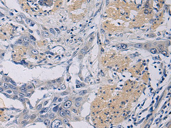 EKLF / KLF1 Antibody - Immunohistochemistry of paraffin-embedded Human esophagus cancer tissue  using KLF1 Polyclonal Antibody at dilution of 1:35(×200)