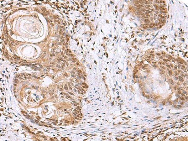 ELAC1 Antibody - Immunohistochemistry of paraffin-embedded Human esophagus cancer tissue  using ELAC1 Polyclonal Antibody at dilution of 1:65(×200)