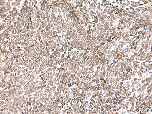 ELAC1 Antibody - Immunohistochemistry of paraffin-embedded Human lung cancer tissue  using ELAC1 Polyclonal Antibody at dilution of 1:65(×200)