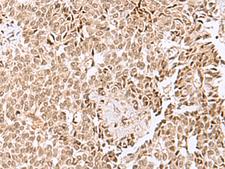 ELAC1 Antibody - Immunohistochemistry of paraffin-embedded Human ovarian cancer tissue  using ELAC1 Polyclonal Antibody at dilution of 1:50(×200)