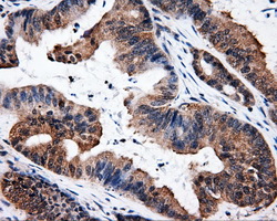 ELAVL1 / HUR Antibody - IHC of paraffin-embedded Adenocarcinoma of colon tissue using anti-ELAVL1 mouse monoclonal antibody. (Dilution 1:50).